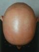 Alopecia Totalis